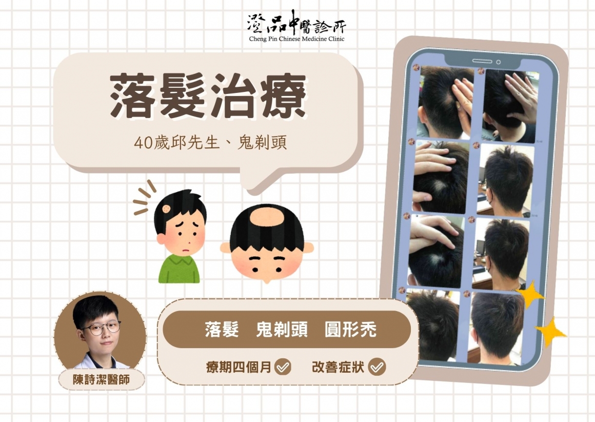 chengpin_drcsj_HairLoss